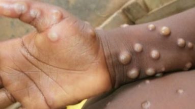 UN denounces ‘racist’ and ‘homophobic’ coverage of monkeypox | Latest English News | WION World News