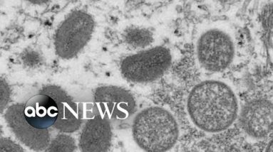 Monkeypox outbreak grows