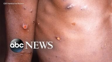 The symptoms, treatment for monkeypox